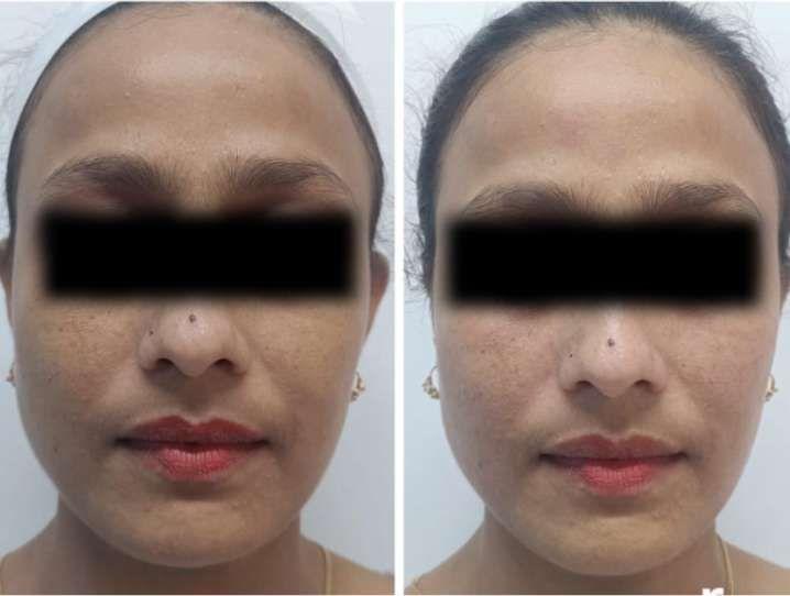 before-after