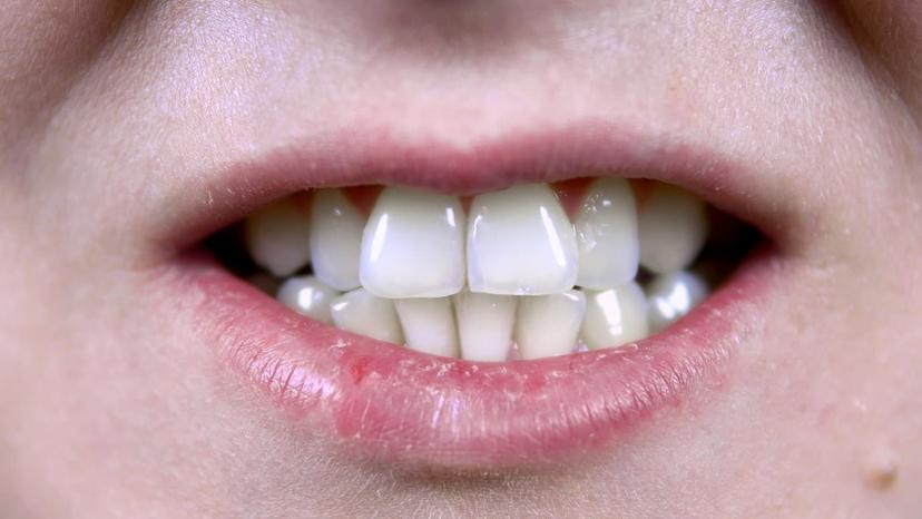 Is Overbite Teeth Making You Underconfident? We Can Fix It