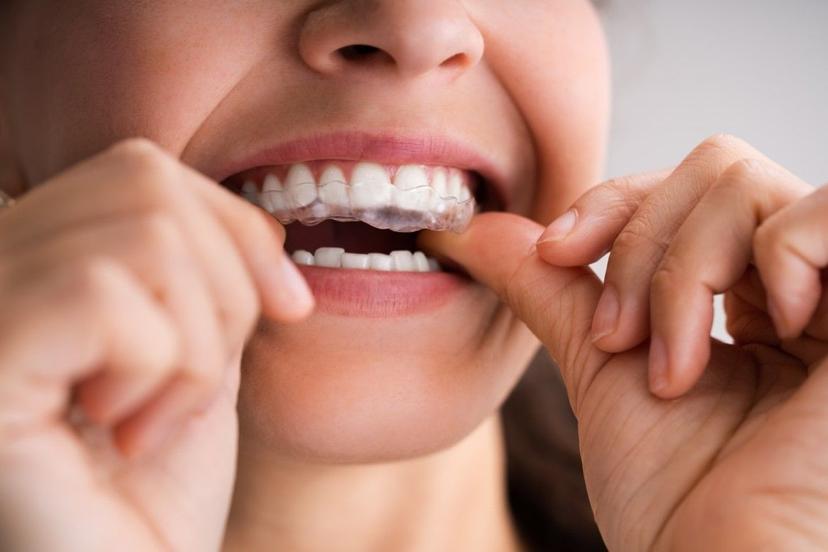 Here’s Everything You Need to Know About Retainers for Teeth