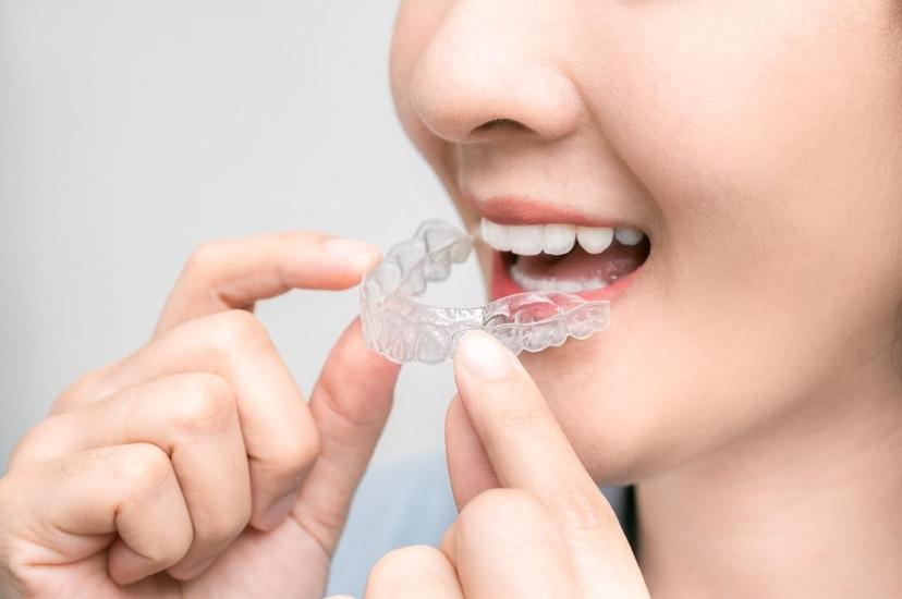 Your Removable Braces Guide: Benefits and Costing