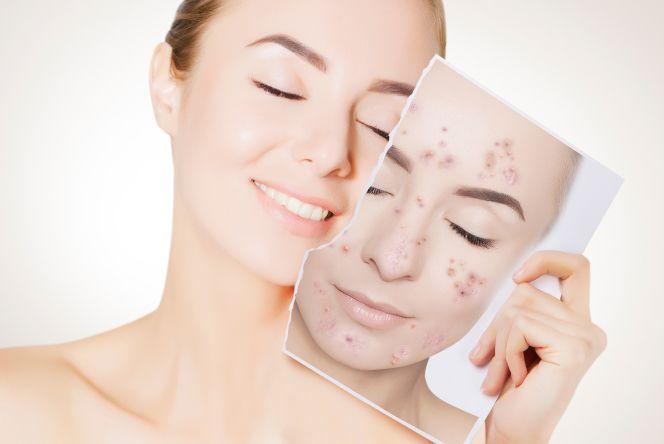 6 Acne Do’s and Don’t That Will Help You Combat Acne Effectively 