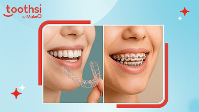  What Most Dentists Don’t Tell You About Aligners vs Braces