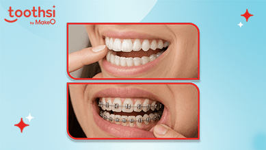 Aligners vs Braces – Which Works Faster for Common Teeth Problems?