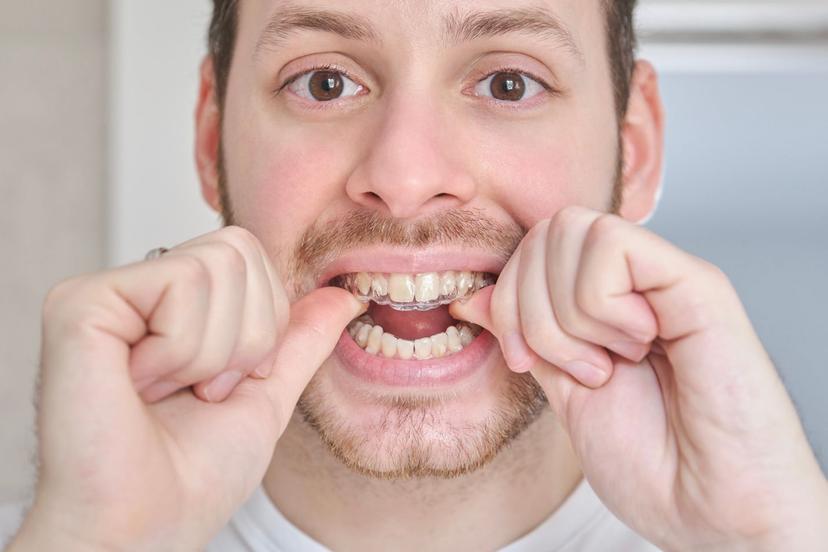 Braces and Gum Disease: All You Need To Know 