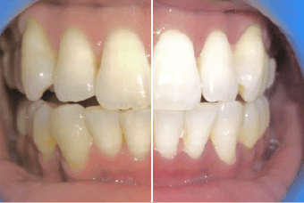 before-after