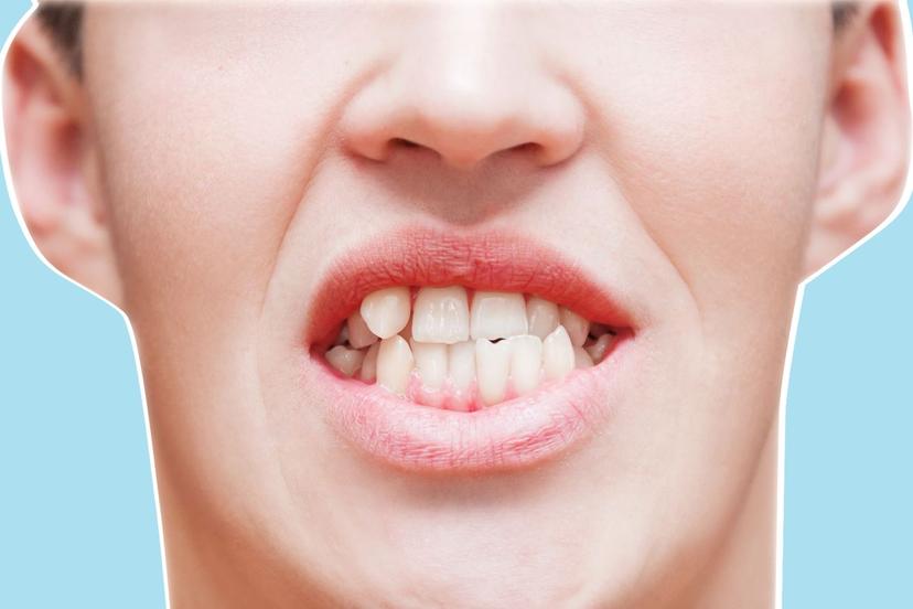 Did You Know: Your Misalignment Could Lead To Tooth Decay?