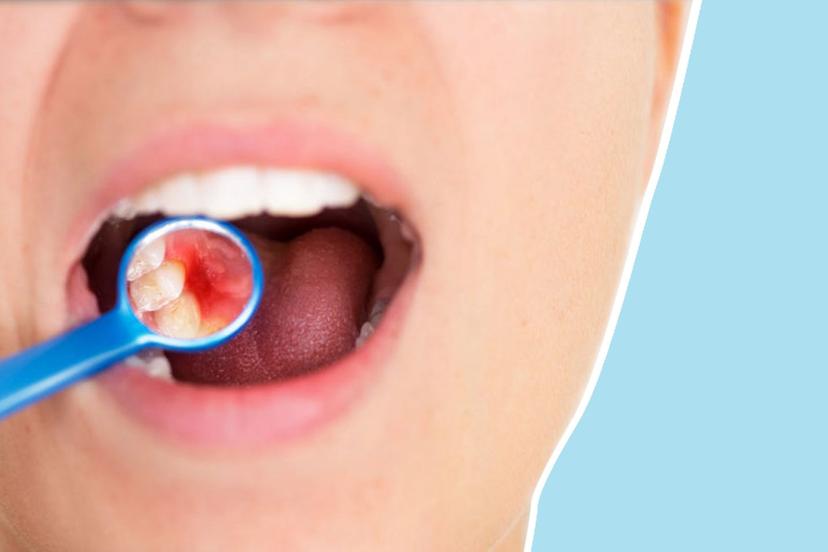 Here’s Everything You Need to Know About Swollen Gums Caused by Braces
