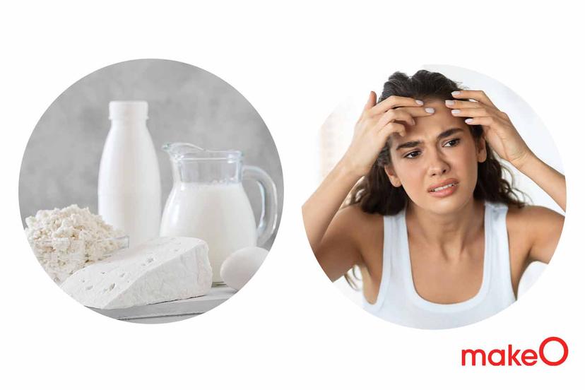 Does Consuming Dairy Cause Acne? Find out