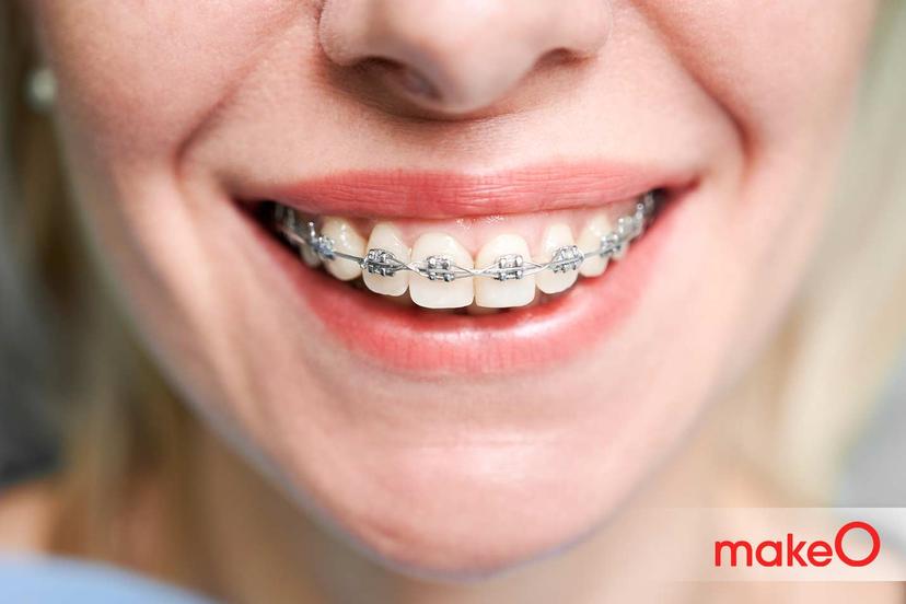 Braces in Adulthood: Is it Possible to Correct Your Teeth Once You’re Older?