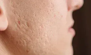 Men’s Acne: How to Navigate, Treat and Prevent Hormonal Acne in Men