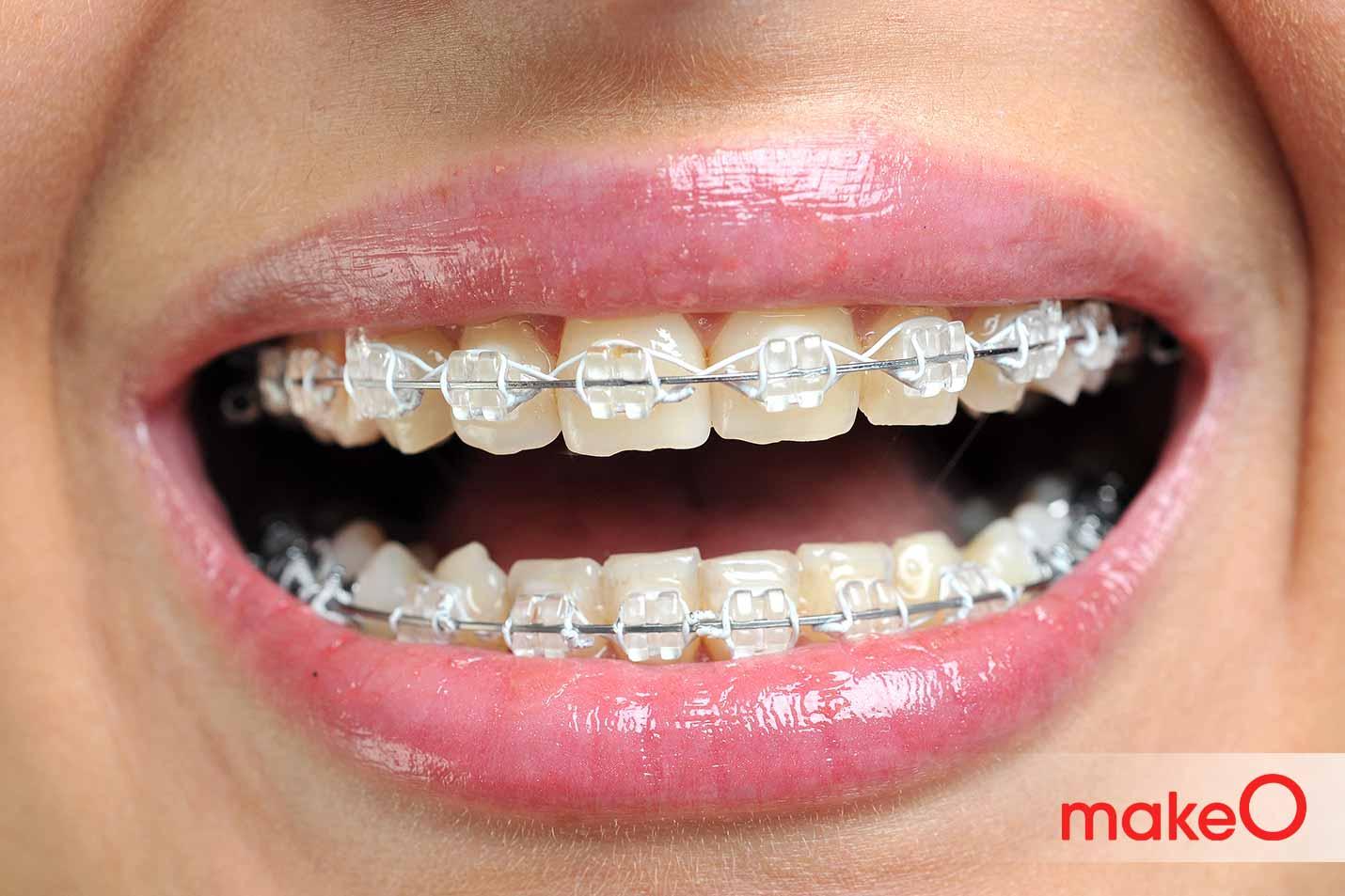 braces care