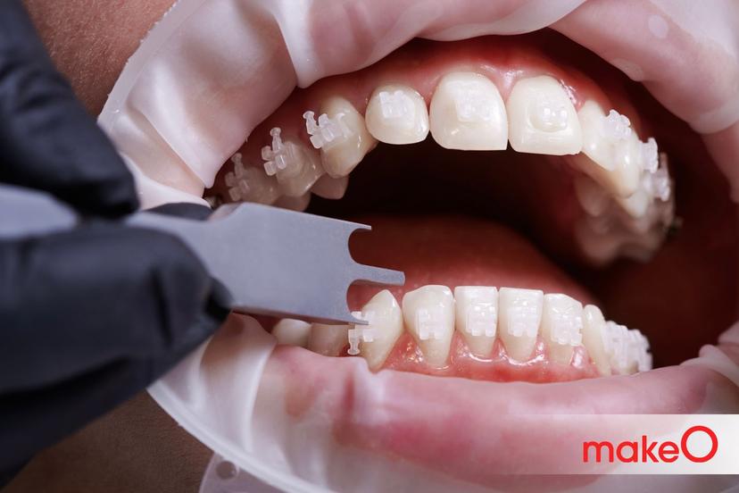 Cheek Retractors: Avoid these 4 Mistakes While Wearing Dental Retractors