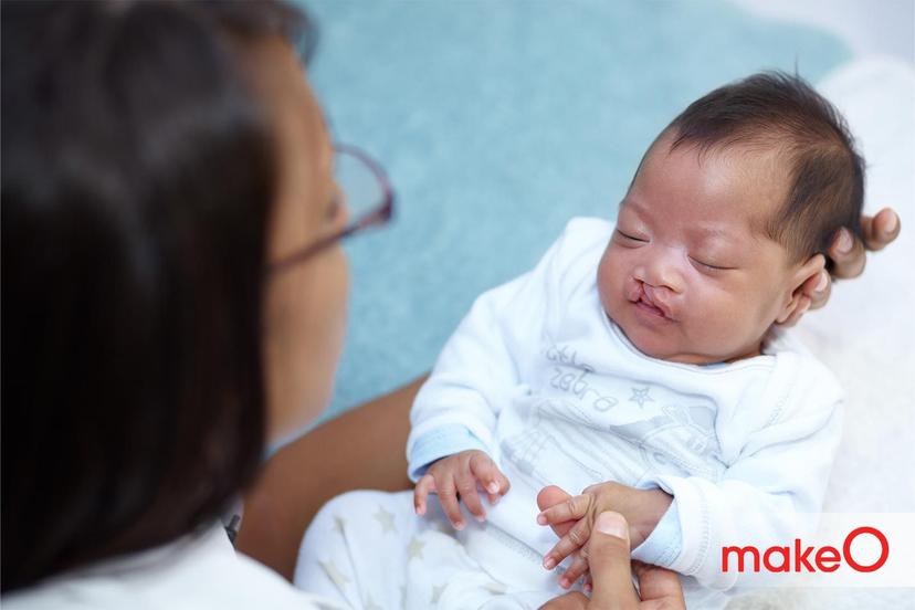 Does Cleft Lip and Palate Affect Oral Health?