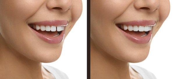 Diastema: Understanding the Causes of Gap in Front Teeth