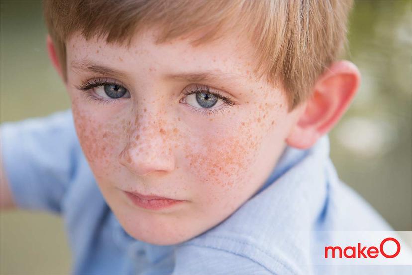 A Comprehensive guide to preventing sun damage for freckled skin