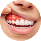 Gum Inflammation