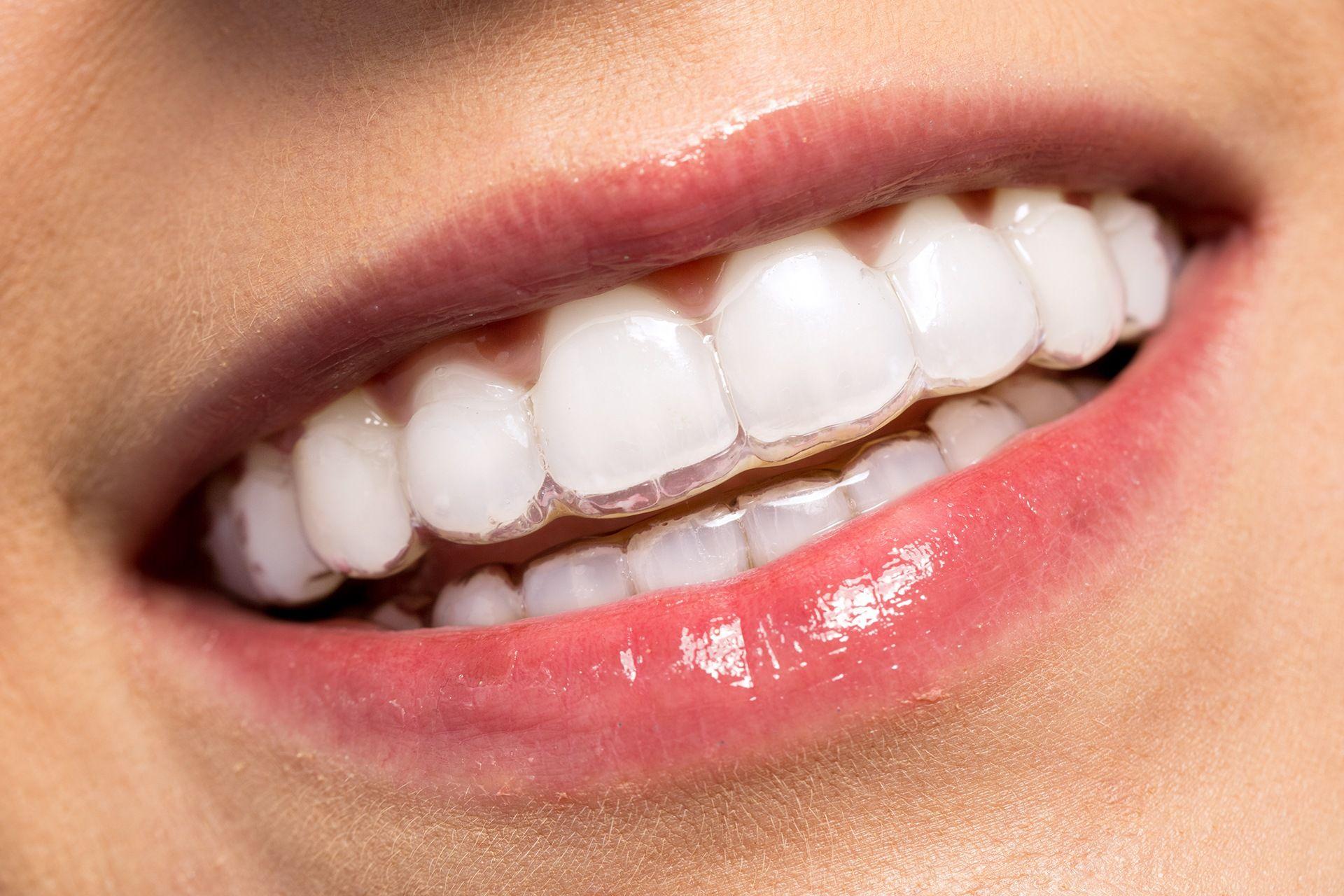 teeth whitening advantages