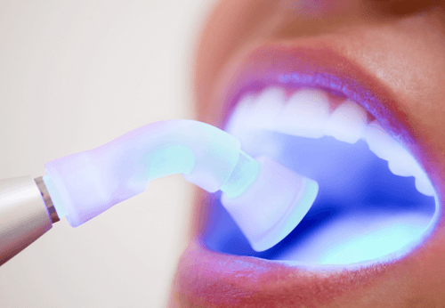 What Is Malocclusion? Causes, Types, and Treatment Options