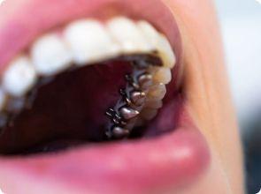 Smile Transformation: Enhancing Self-Esteem with Braces