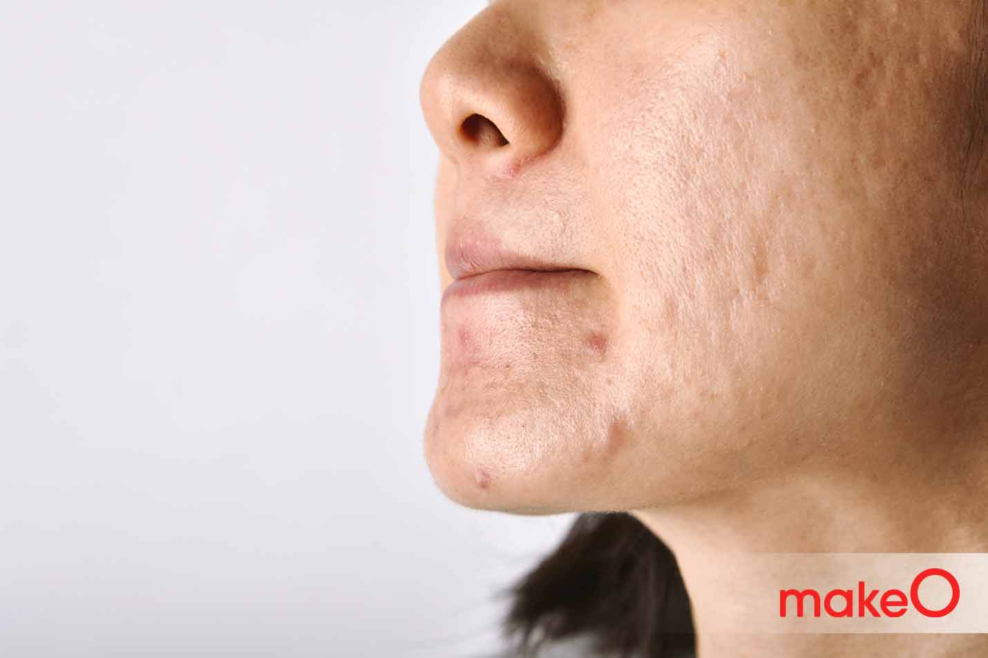 acne around mouth