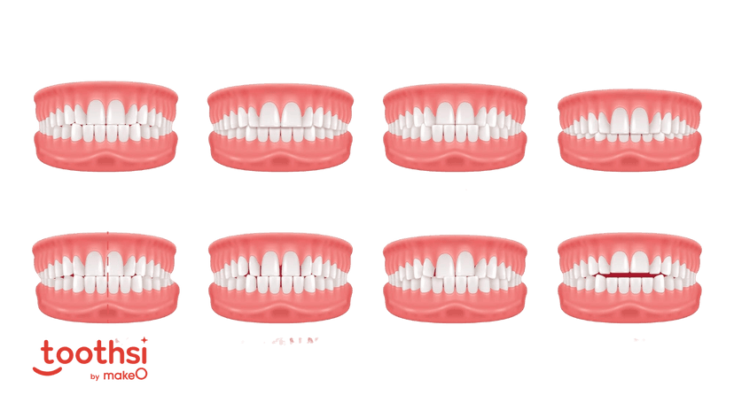 Understanding Malocclusion: Causes, Effects and Treatments