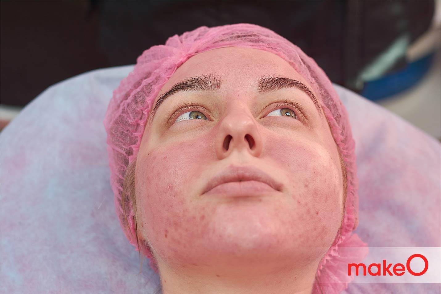 rosacea meaning