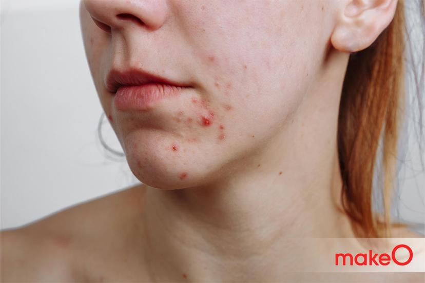 Red Bumps On Skin? Know About Pustule Acne & Papules On Face
