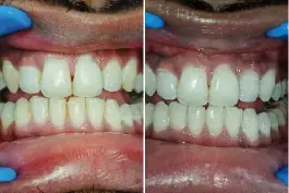 before-after