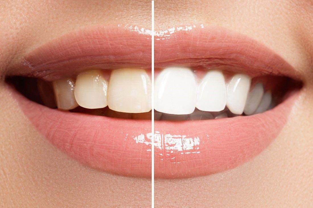 teeth whitening at home
