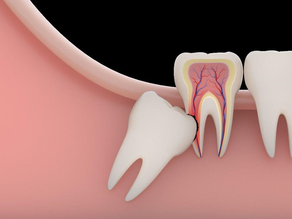 tooth erosion causes 