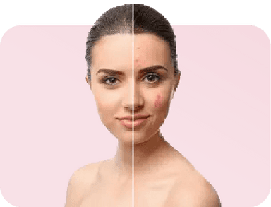 Acne & Scar Treatments_image