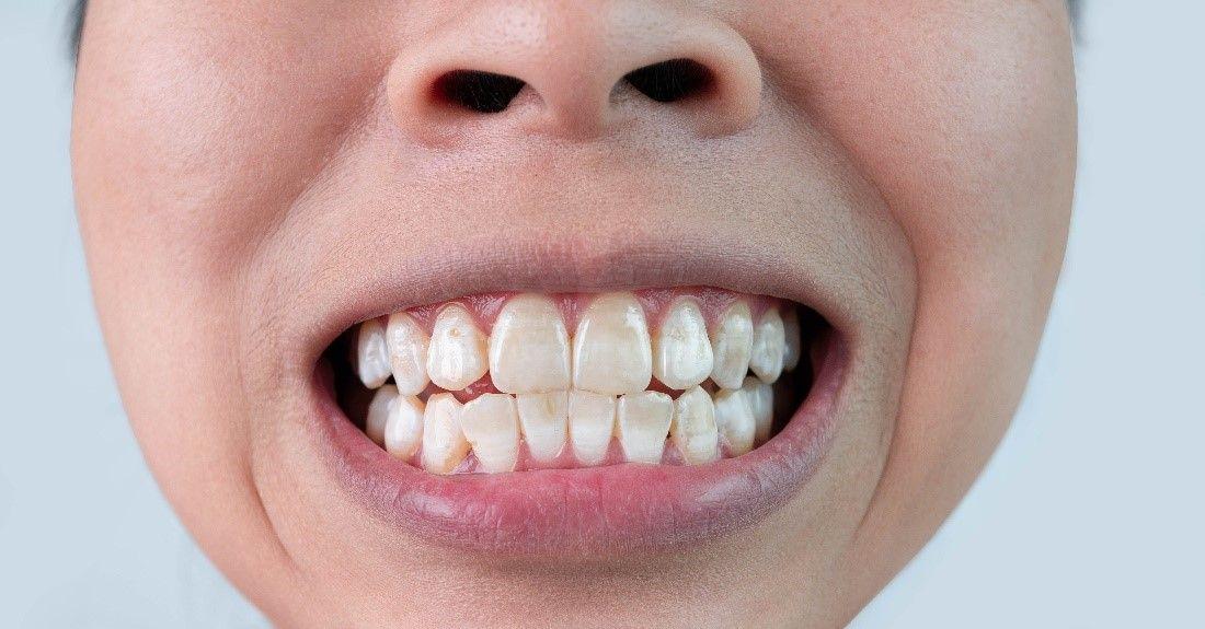 white spot on teeth causes